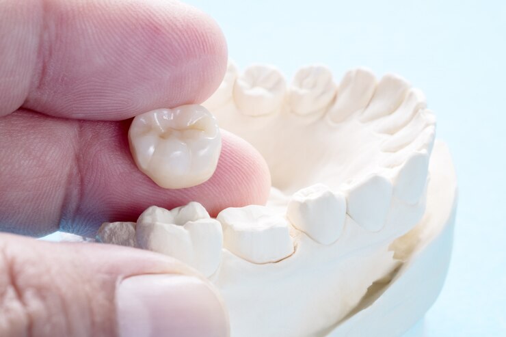 Closeup / Prosthodontics or Prosthetic / Crown and bridge equipment and model express fix restoration.