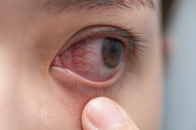 Closeup Red eye of woman