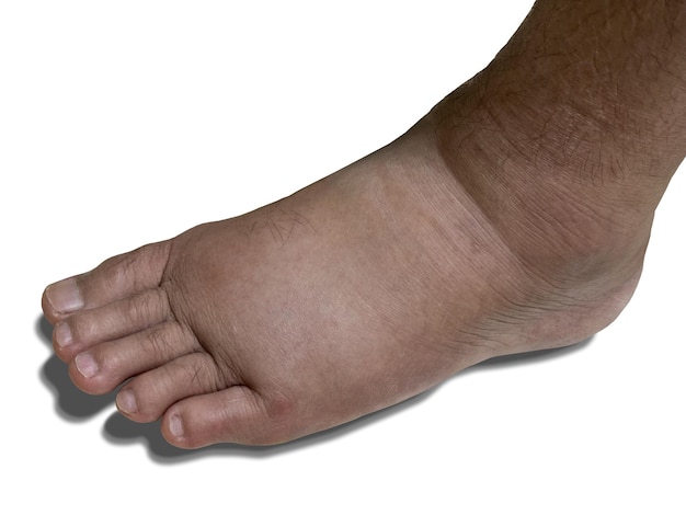 Photo closeup swollen left foot as a result of ankle pain isolated on white