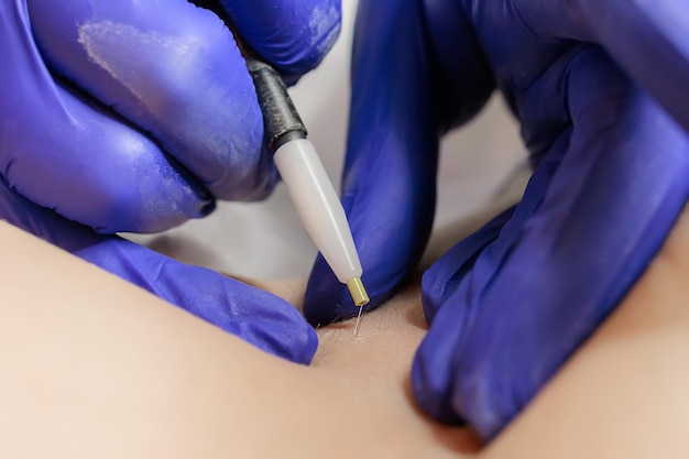 Closeup of the tip of the hair electrolysis device where the doctor inserts the needle into the hair follicle