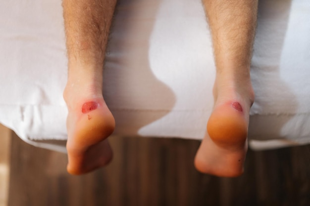 Closeup top view feet with calluses on heels of unrecognizable man lying down on massage table in luxury spa salon Close up cropped shot of painful wound on mans feet caused by new shoes