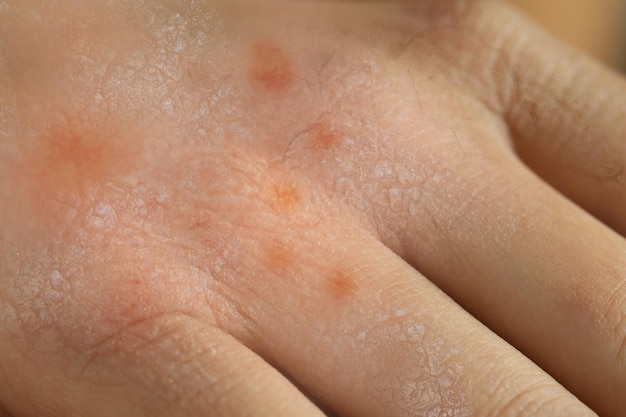 Closeup view of person with dry skin on hand