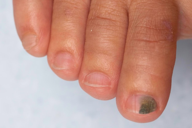 Photo a closeup view on the toes of a young child with tinea unguium a fungal infection of the toenail