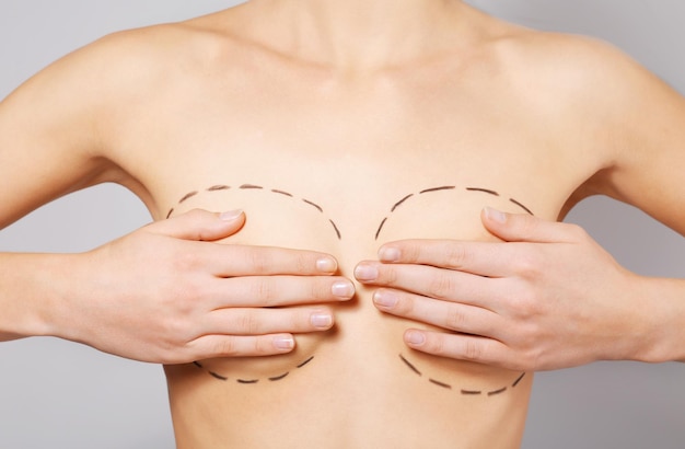 Closeup view of young woman with breasts marked for plastic operation on light background