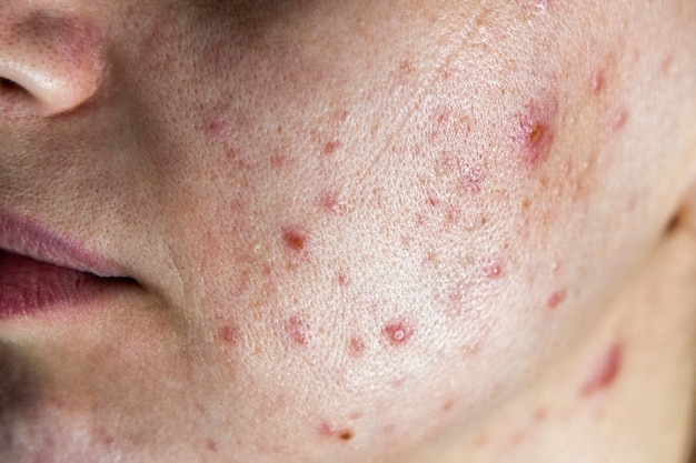 Photo closeup of woman face with bad skin and red acne.