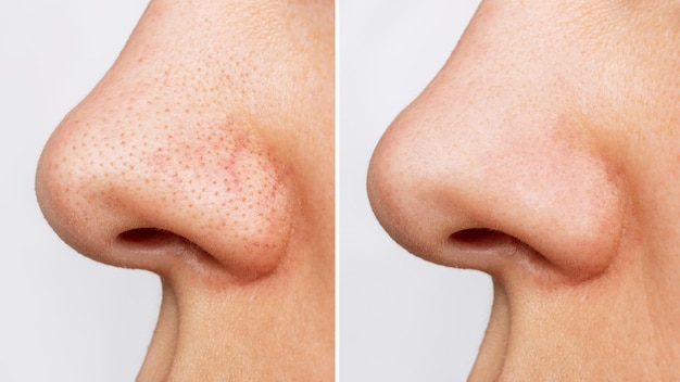 Closeup of woman nose with blackheads or black dots before and after peeling and cleansing face