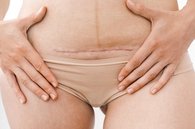 Photo closeup of woman's belly with a scar from a cesarean section
