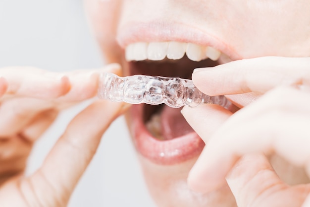 Closeup of woman's mouth putting on a transparent retainer with soft natural lighting