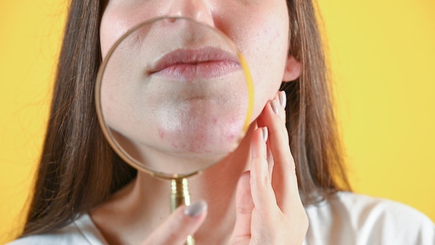 Closeup of a woman39s chin with rashes through a magnifying glass Aleergy and acne concept High quality photo