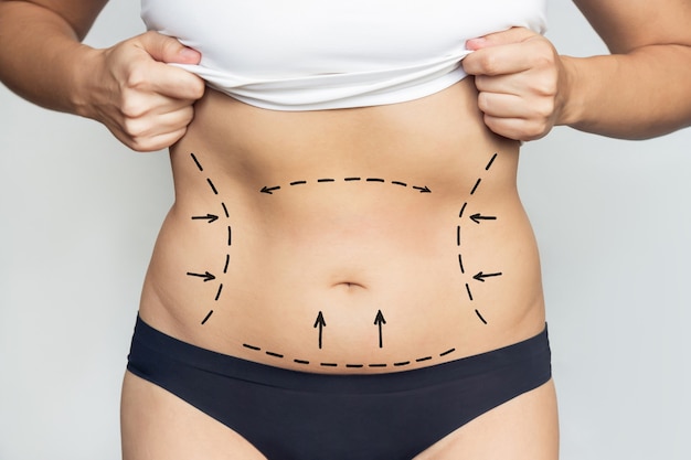 Closeup of a womans belly with excess fat with marking on her body Liposuction plastic surgery