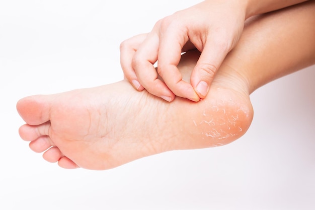 Closeup of a womans foot with peeling skin on the heel  A young woman scrubs foot Allergies eczema