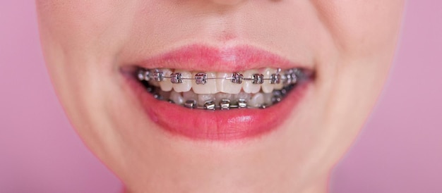 Клоуз-ап молодой женщины, улыбающейся с брекетами на зубах Система брекетов в улыбающемся рту макрофото зубы крупный план губы макро снимок
