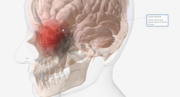 Кластерные головные боли — редкий и чрезвычайно болезненный тип головной боли.