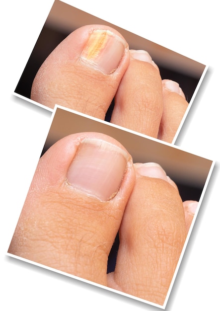 Collage comparison of before and after successful treatment for fungal infection Big toe of caucasian adult suffering fungal infection causing yellowing of nail Medicine and health care conceptxAxDxA