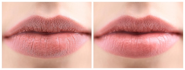 Collage met foto's van de vrouw voor en na het gebruik van lippenbalsem close-up