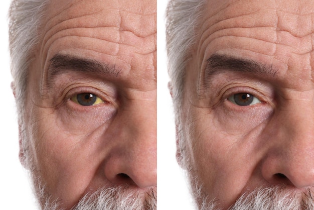 Collage with photos of senior man before and after hepatitis treatment focus on eyes