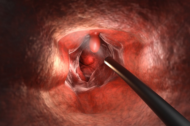 Colonoscopy technology with endoscope inside of intestine with polyp