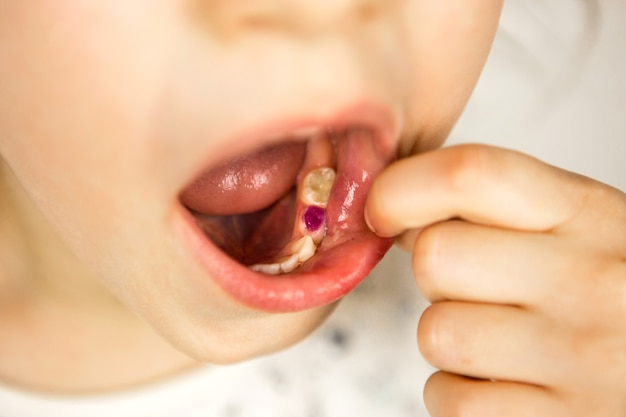 Colored purple filling on the girl\'s milk chewing tooth.\
pediatric dentistry, treatment and examination. a child with an\
open mouth shows a tooth in close-up on a white background.