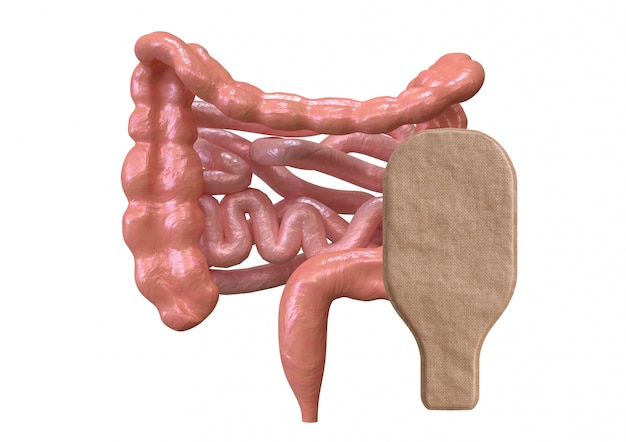 Colostomiezak verbonden met geïsoleerde darm