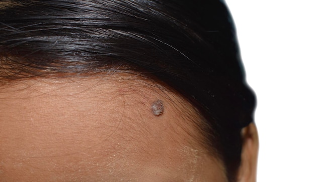 Common wart at the forehead of Asian man It is a small hard benign growth on the skin