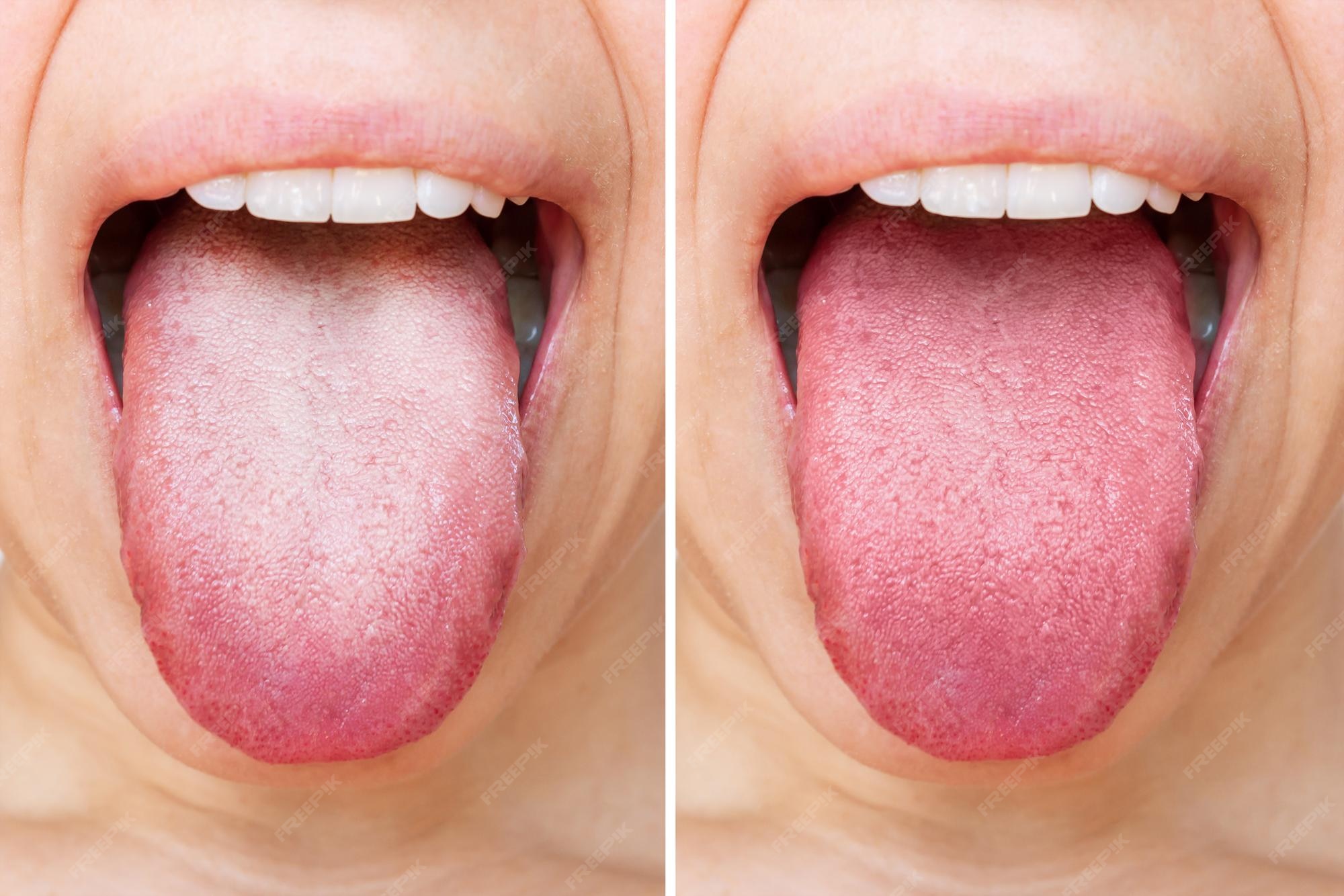 Premium Photo Comparison of diseased tongue with white plaque and