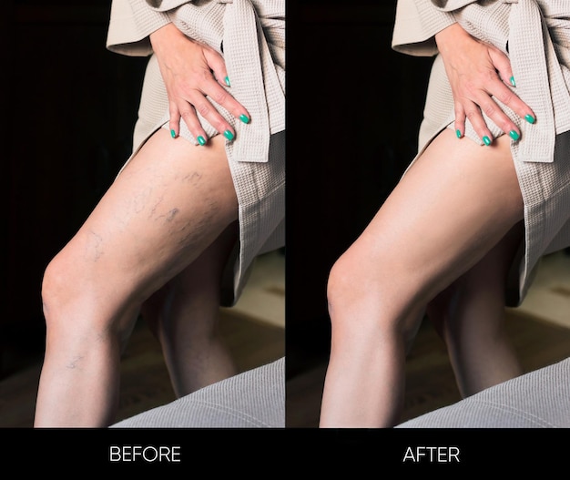 Comparison of two photos - before and after treatment of varicose veins