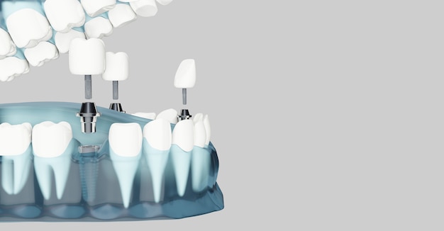 사진 치과 임플란트 및 복사 공간의 구성 요소. 파란색 투명. 3d 일러스트