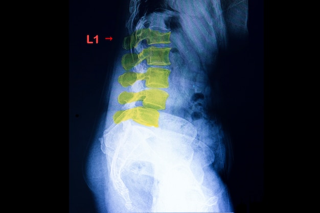 Photo compression fracture of lambar spine