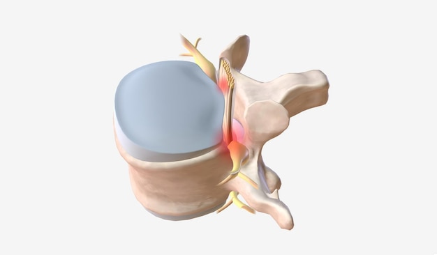 Photo the compression of spinal canal