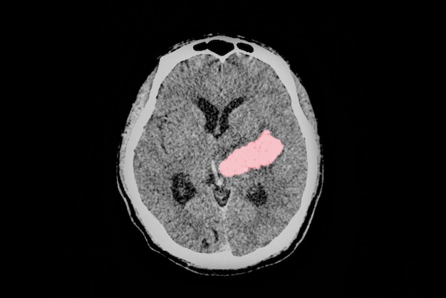 A computer tomography image of brain and skull showing large intracerebral hemorrhage