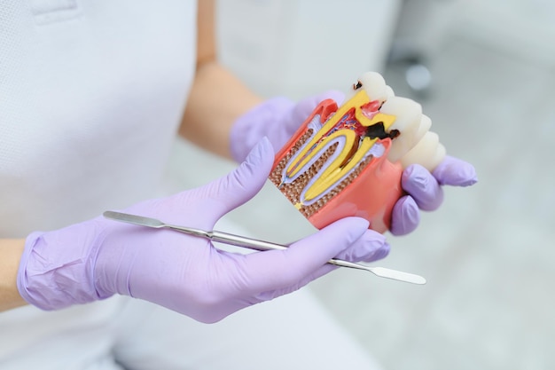 The concept of diagnosis and treatment of tooth disease Doctor shows a model of a sick tooth