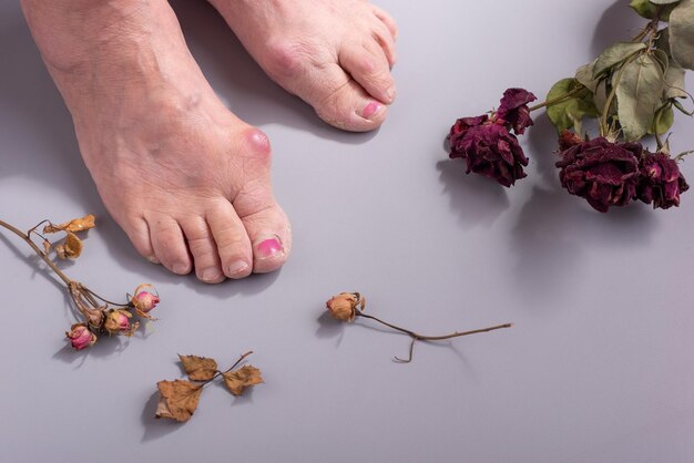 Concept of foot disease in old woman with dry flowers