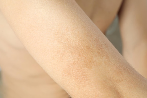 Concept of skin care hand of young man with brown spots