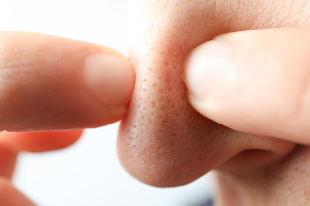 Photo concept of skin care with nose with dots