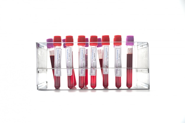 Coronavirus blood samples in test tubes