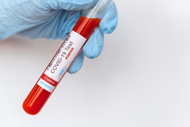 Coronavirus infected blood sample in tube in hand of scientist on white background