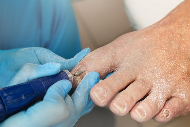 Correctie en behandeling van misvormde teennagels na schimmelinfecties