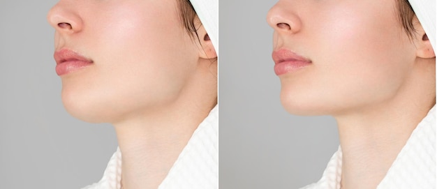correction of the chin shape liposuction of the neck the result of the procedure in the clinic of