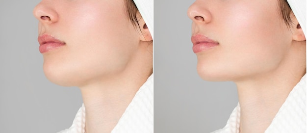 Correction of the chin shape liposuction of the neck the result of the procedure in the clinic of