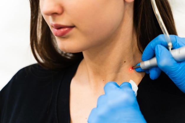 cosmetologist applies laser removing device to get rid of birthmarks laser cleaning skin from moles in cosmetology clinic