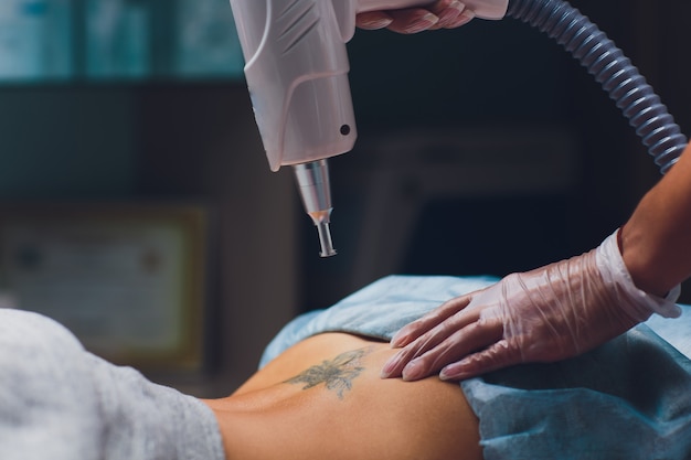 Cosmetologist doing professional tattoo removal laser