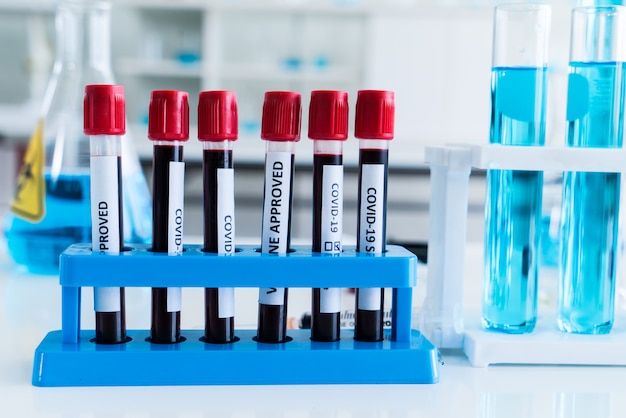 Photo covid-19 blood test in glass tube at medical laboratoryw