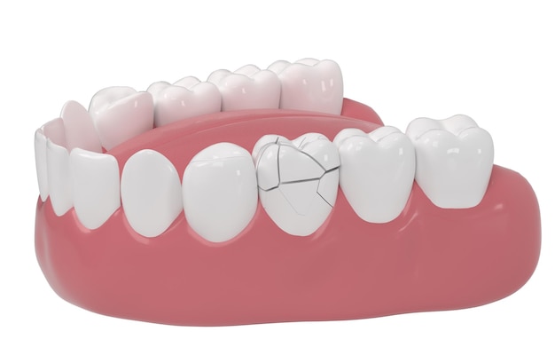 Crack tooth tooth disease 3d rendering