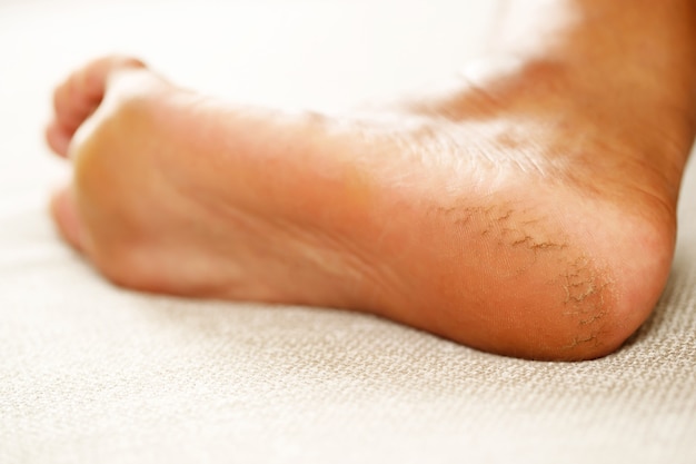 사진 갈라진 뒤꿈치 치료 풋 크림은 정기적으로 발라야 합니다. 크림이 잘 흡수되도록 발뒤꿈치를 문지르며 마사지합니다. 발 피부에 수분 공급에 도움