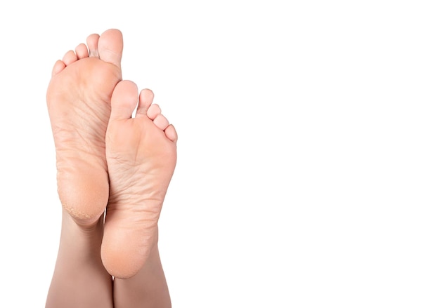 Cracked heel on woman foot Female feet turned up Dry heels and soles woman on white background closeup dry skin on heels and soles needs care