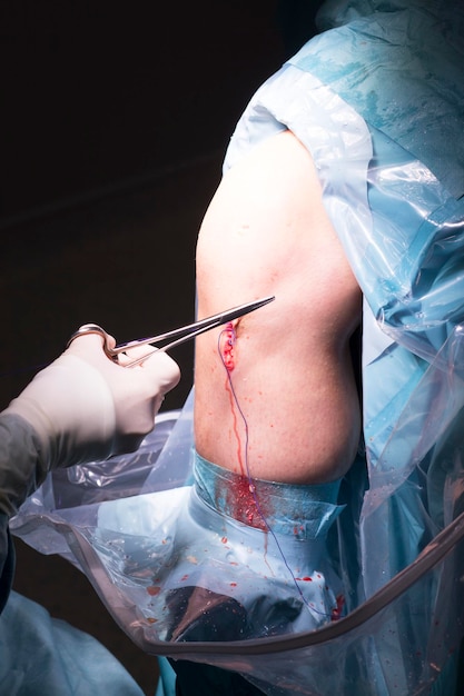 Photo cropped hand of doctor stitching patient in hospital