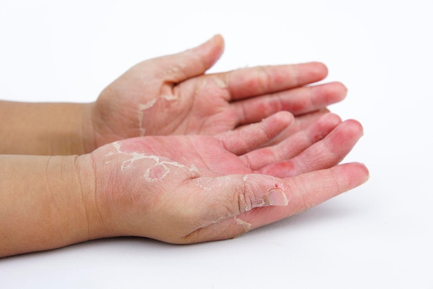 Cropped hands with skin condition over white background