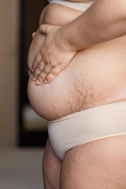 자른 이미지 뚱뚱한 과체중 여성이 스트레치 마크가 있는 팔에 배를 안고 있습니다. 빠른 체중 증가 건성 피부