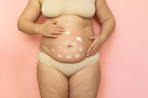 Cropped overweight woman in underwear applying moisturizer gel cream to her dehydrated abdomen Cellulite obesity