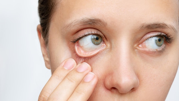 Cropped shot of a young caucasian woman showing off her pale conjunctiva. Iron deficiency anemia